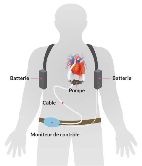 assistance ventriculaire cardiaque dispositifs doctissimo dispositif insuffisance soulager soigner